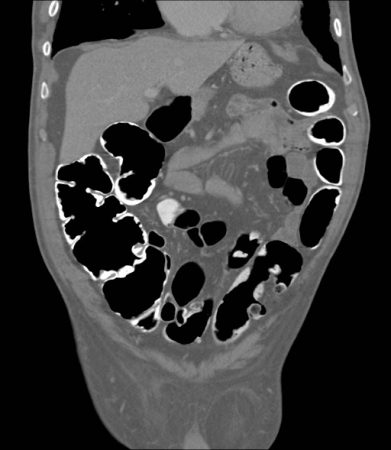 CT Colonography