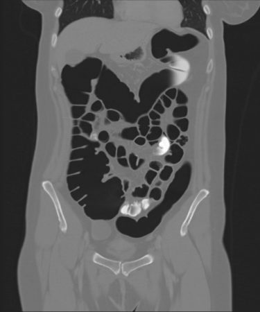 CT Colonography1